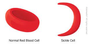 Sickle cell survivor advocates mandatory testing for intending couple.