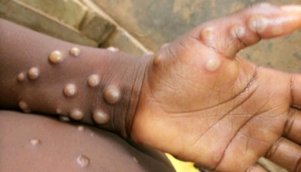 NIGERIA: Abia State Reports First Confirmed Case of Monkeypox