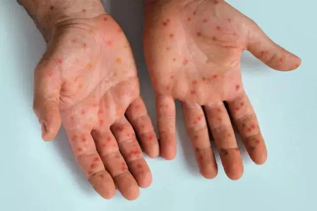 Nigeria: NCDC confirms 55 mpox cases in 21 states, FCT.